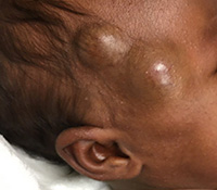 Deep infantile hemangioma